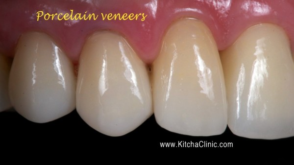 Porcelain veneers