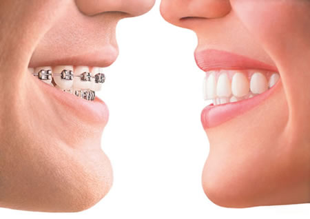 จัดฟัน ดัดฟัน Invisalign