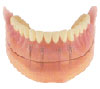 Implant Dentures