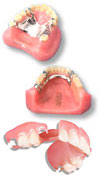 Partial Dentures